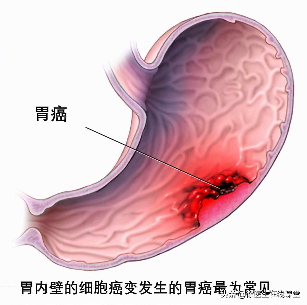 图片[1]-胃癌的预警信号：三种身体表现提示你该就医了-瑞禾养生网